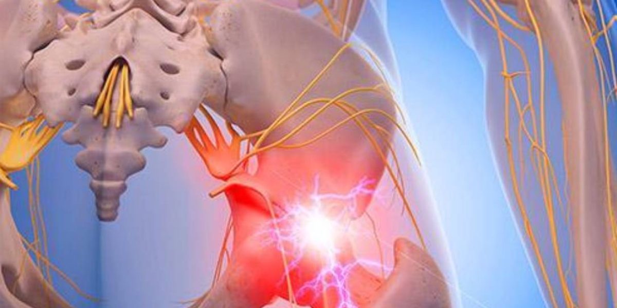A New Strategy for Treating Sciatica Pain